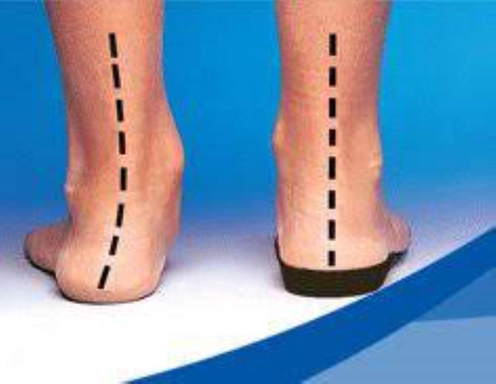 Flat feet problem resolved with insoles