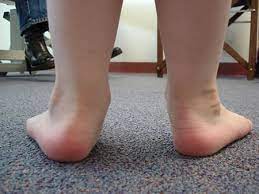Kid Flat Feet